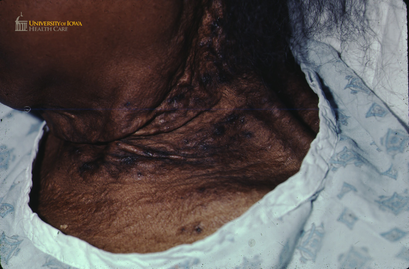 Numerous hyperpigmented papules and a background of lax skin with increased skin folds on the neck. (click images for higher resolution).